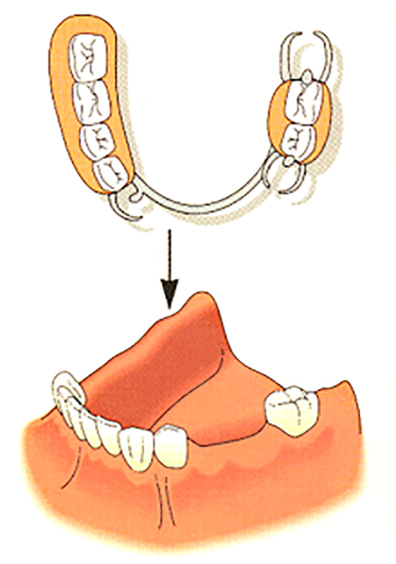 部分入れ歯