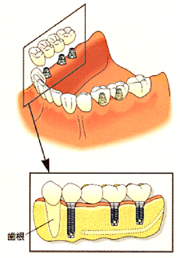 インプラント