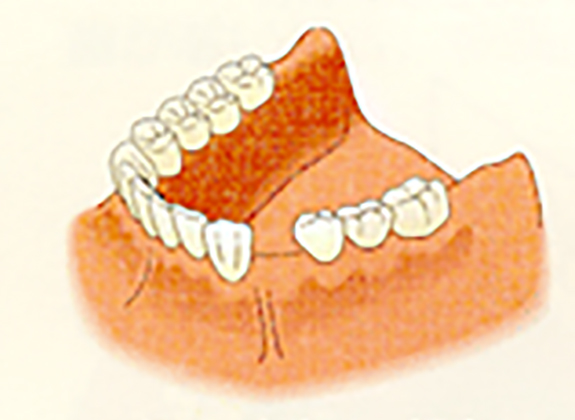 歯を１本失った場合
