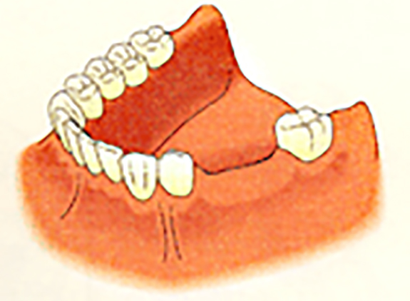 歯を何本か失った場合