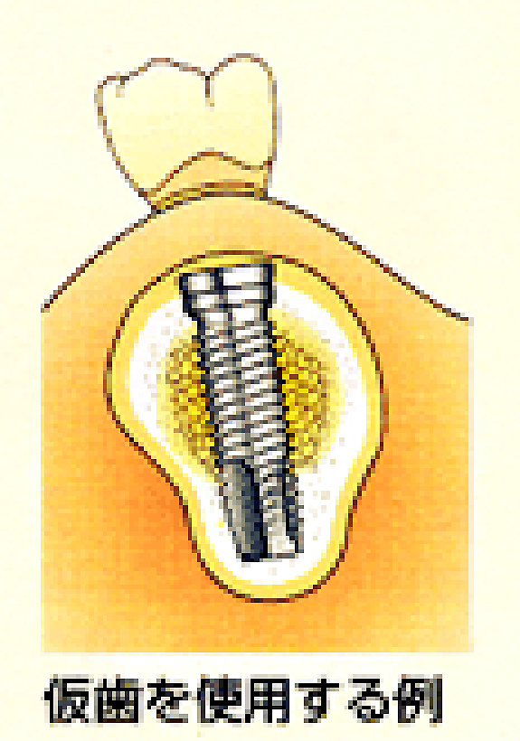 仮の歯の使用例